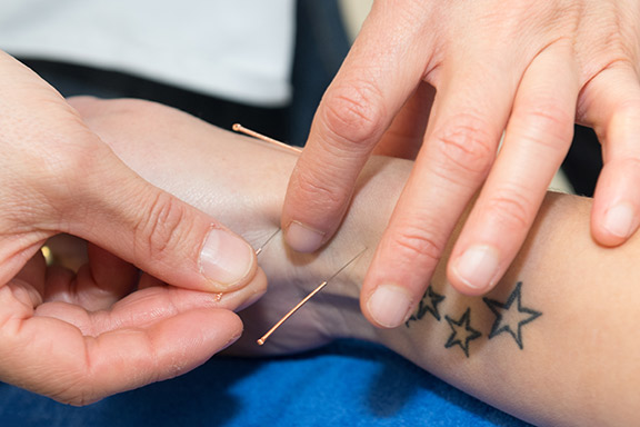 Akupunktur Nadelstechen
